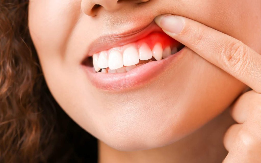 entzündetes Zahnfleisch einer Frau