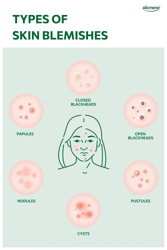 types of skin blemishes infographic