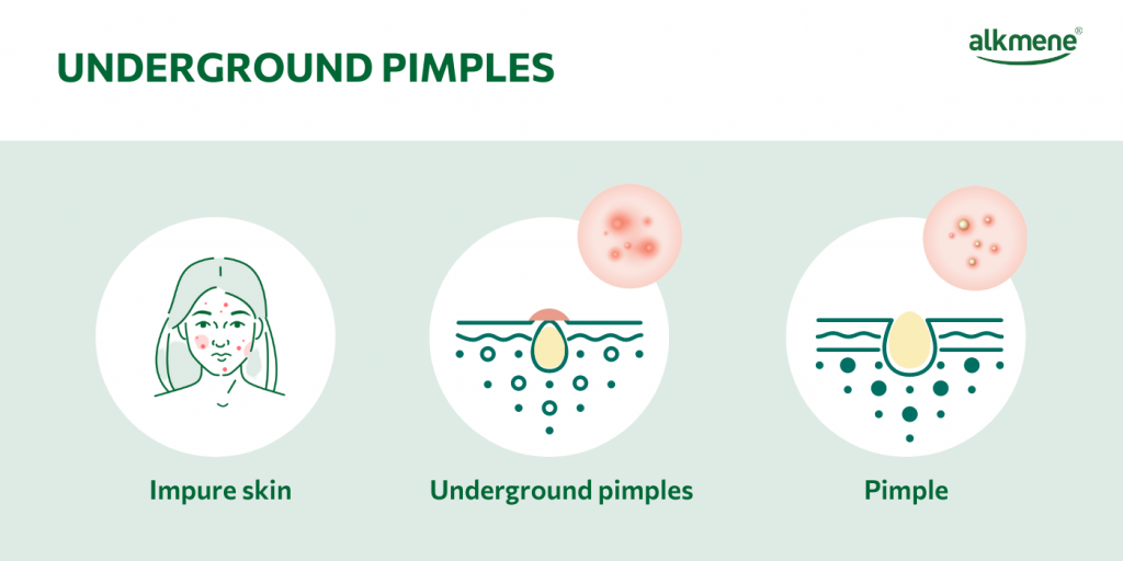 Infografik-underground-pimples