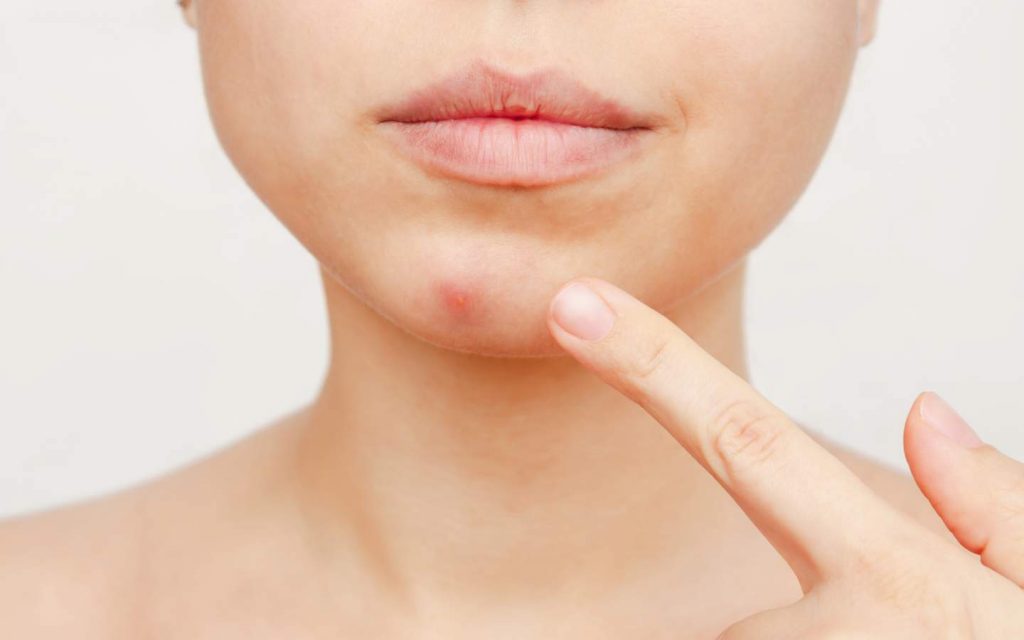 Woman with pimple on her chin