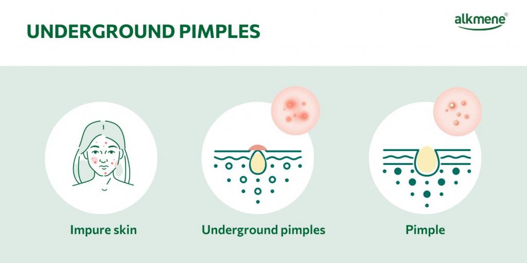 Infografic how underground pimples develop 
