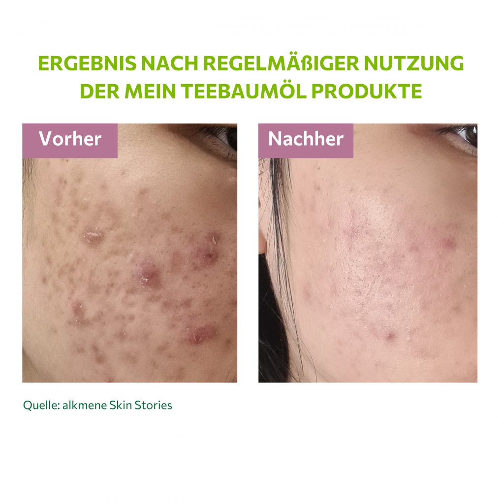 Elegantes Teebauml Pickel Vorher Nachher Bild