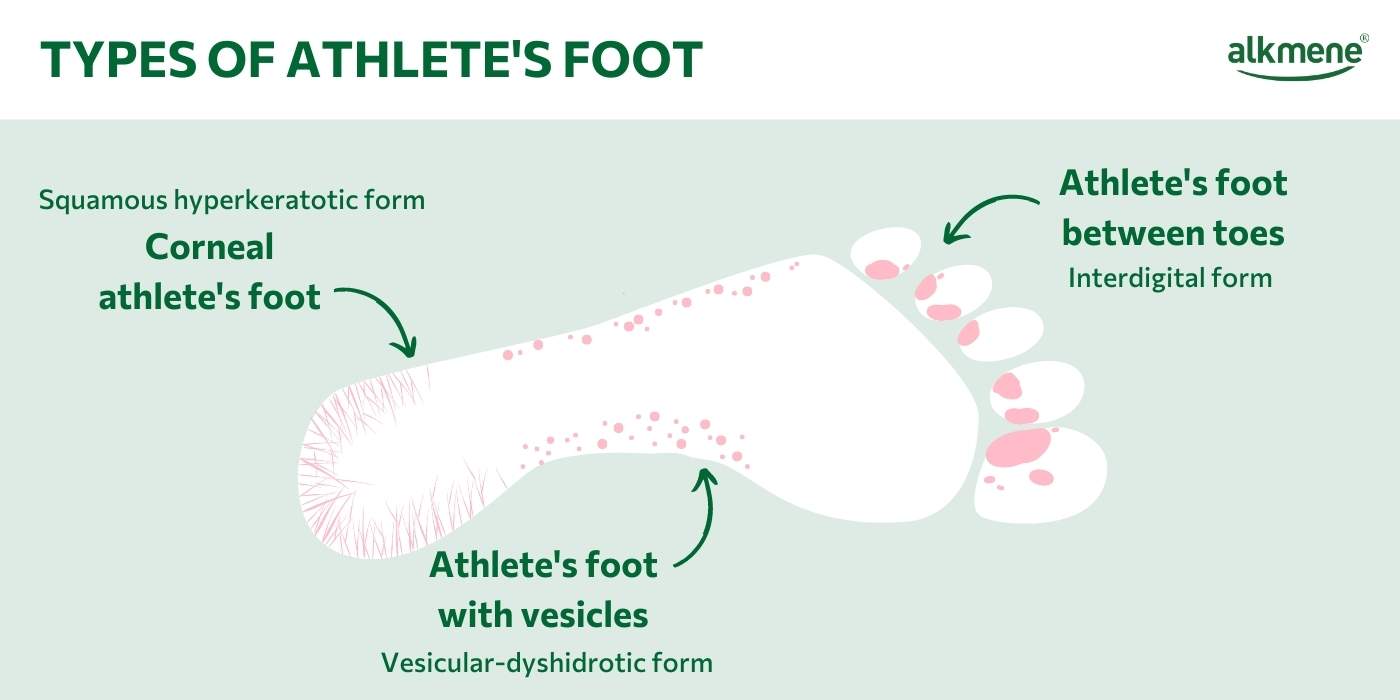 Infografic on types of athletes foot