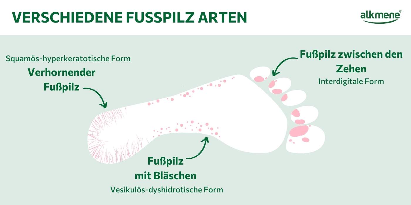 Infografik zu den drei verschiedenen Arten von Fußpilz