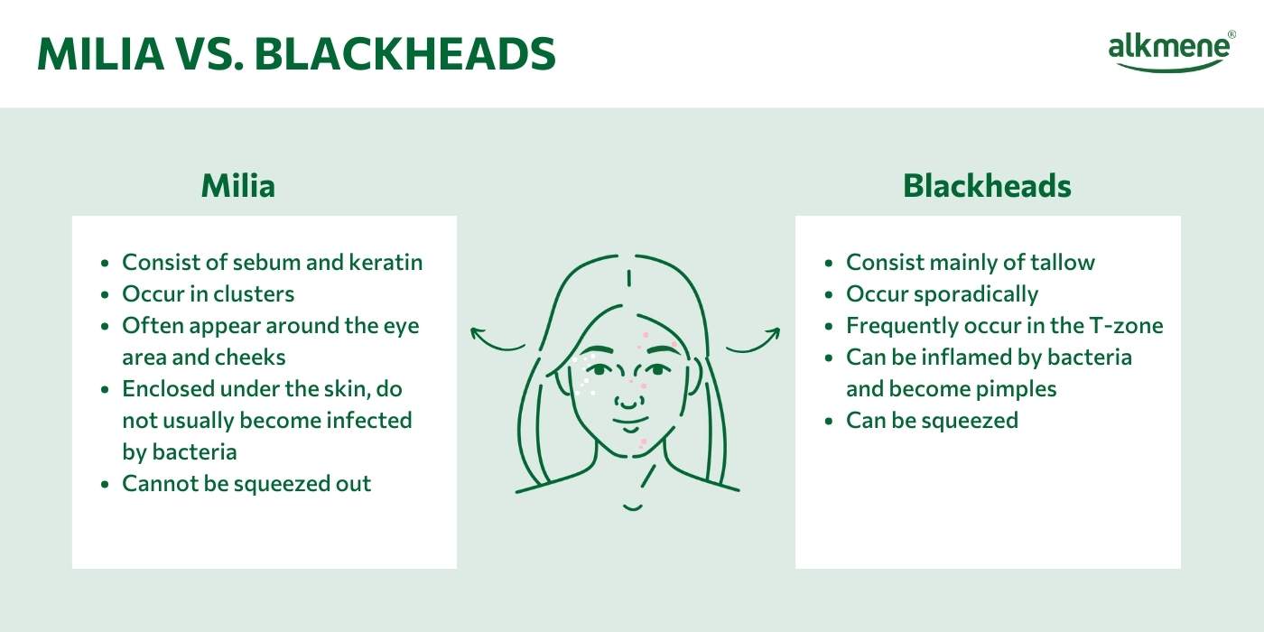 Infografic on the differences between milia and blackheads 