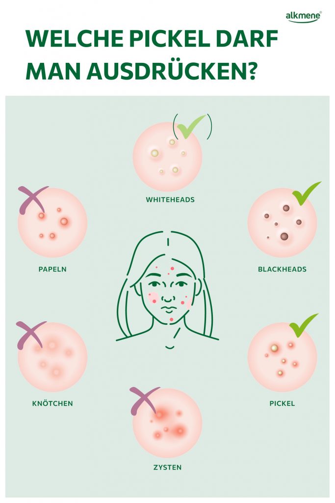 Infografik, welche Arten von Hautunreinheiten und Pickeln man ausdrücken darf und welche nicht