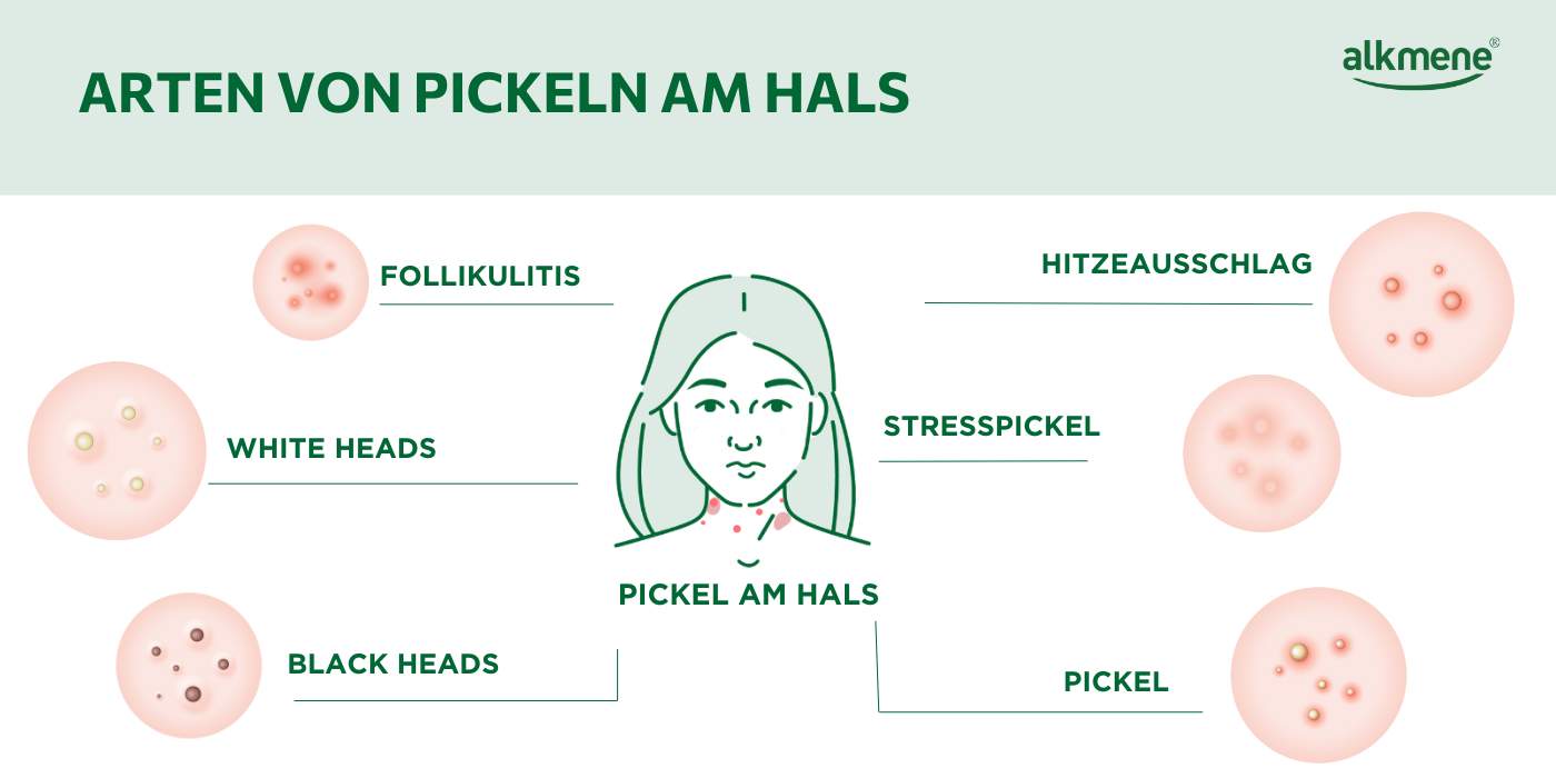 Infografik, die die verschiedenen Arten von Pickeln und Eiterpickeln am Hals zeigt